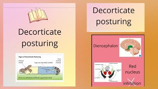 DECORTICATE POSTURE Abnormal posturing [upl. by Justina656]