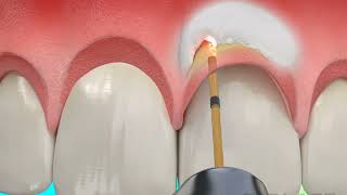 Dental Treatment  Osseous Crown Lengthening with Waterlase Laser Dentistry [upl. by Lokin]