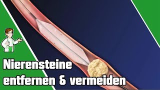 Nierensteine entfernen und vermeiden  SO geht es 👨‍⚕️ [upl. by Lenor]