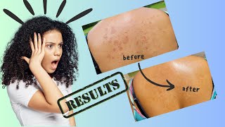 Amazing Natural Remedies for Eczema Relief  Bye Itchy Skin [upl. by Egor]