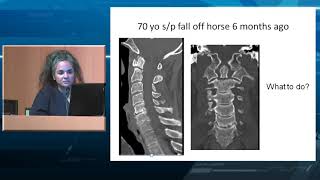 Management of Odontoid Fractures [upl. by Airdnua]