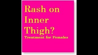 Rash on Inner Thigh for Females Best Formula [upl. by Grishilde83]