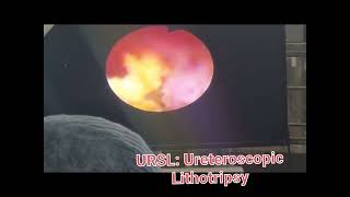 URSL Ureteroscopic Lithotripsy [upl. by Urdna]