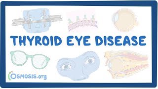 Thyroid Eye Disease causes symptoms diagnosis treatment pathology [upl. by Aniret]