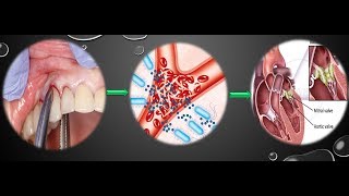 Infective Endocarditis and its dental consideration [upl. by Annaerb]