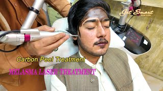 melasma laser treatment Carbon Peel Laser  4k video [upl. by Ardell]