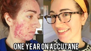 ACCUTANE Before And After Severe Acne With Pictures My Experience  Jess Bunty [upl. by Benedikta]