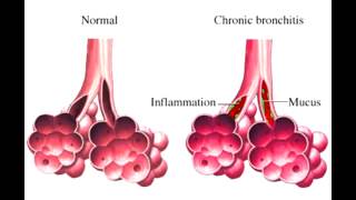 Chronic Bronchitis  quotblue bloaterquot [upl. by Damara]