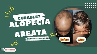 ALOPECIA AREATA  कीड़ा लगना क्या ये ठीक होता है जानिए इसके बारे में  beforeandafter alopecia [upl. by Uyerta]