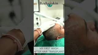 First Hair Wash After Hair Transplant  1st Head Wash  Scabs Removal [upl. by Akenal]