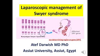 Laparoscopic management of Swyer syndrome [upl. by Blen]