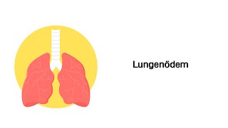 Lungenödem  Erkrankungen der Atemwege [upl. by Errehs]