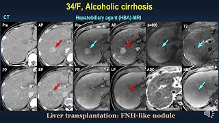 Are these true HCC mimickers in cirrhotic liver Part 1 Benign [upl. by Siobhan279]