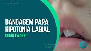 Bandagem para hipotonia labial [upl. by Weiler]