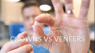 CROWNS VS VENEERS  Which is best [upl. by Abbub405]