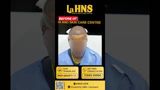 quotRegain Your Confidence Regrow Your Hairquot  Lahns  Hair transplant  Coimbatore [upl. by Cedric]