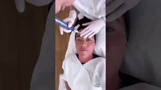 SkinPen microneedling behandeling in Amsterdam met Naomi van As [upl. by Longawa]