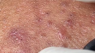 Acne Treatment Huong Da Nang568  2023 [upl. by Evangelin51]