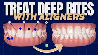 Deep Bites and Aligners  How to Improve Predictability  PDP170 [upl. by Sell]