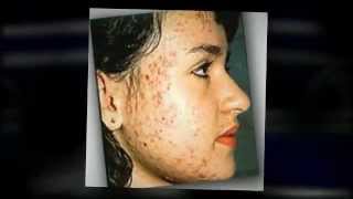 Best Product to Remove Acne Scars  Acne Treatment Products [upl. by Hareehat]