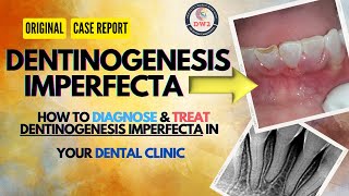 DENTINOGENESIS IMPERFECTA AN ORIGINAL CASE REPORT dentist youtubegrowth youtubegrow dentistry [upl. by Marget]