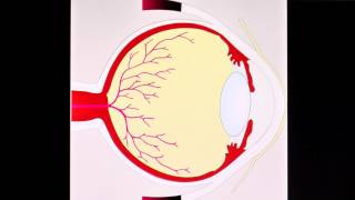 Diabetische Retinopathie [upl. by Reamonn]