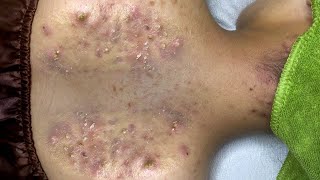 Big Cystic Acne Blackheads Extraction Blackheads amp Milia Whiteheads Removal Pimple Popping  2384 [upl. by Nomzzaj]