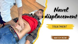 Navel displacement treatment in india [upl. by Alaehs475]