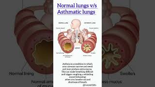 Normal lungs vs asthmatic lungs  viralshorts asthma lungs respiration [upl. by Atinat]