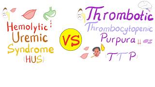 Hemolytic Uremic Syndrome HUS vs Thrombotic Thrombocytopenic purpura TTP [upl. by Enomsed]