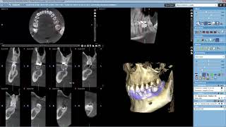 Planmeca Romexis 3D Implant Planning with open STL and crown library [upl. by Sherwin]