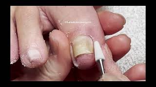 Pedicure Tutorial Toenails that are Squeezing TBT [upl. by Aliahkim22]