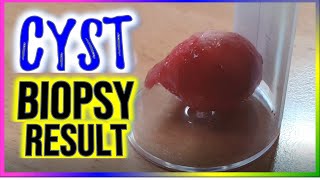 Sebaceous Cyst Excision  Checkup  Biopsy  April 2024 [upl. by Hollie562]