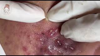 Relax Every Day acne pimplepopping blackheads [upl. by Teage]