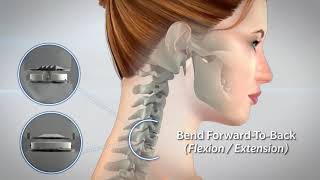 Dr Fautheree Discusses Procedure for Cervical Disc Disease [upl. by Socrates]