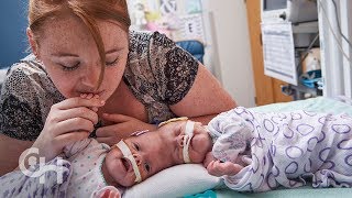 Conjoined Twins Abby and Erin Delaney A Year in the Life [upl. by Down]