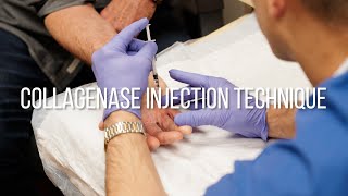 Collagenase Injection Technique for Dupuytrens Contracture [upl. by Zimmermann]