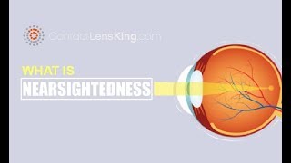 What is Nearsightedness What Causes Myopia [upl. by Henka]