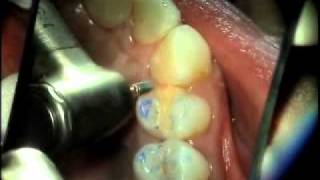 V3105  Uncomplicated Occlusal Equilibration [upl. by Eneleahcim]