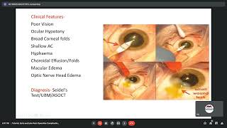 Early and late postoperative complication of cataract surgery Dr Pranav Patil 04 June 2021 [upl. by Garrity813]