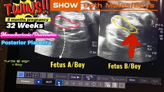 32 Weeks Twins  Boy  Boy  Both Male Fetus  Turtle 🐢 sign  Posterior Placenta  Ultrasound [upl. by Mireille]