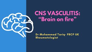 CNS VASCULITIS “Brain on fire” [upl. by Mario783]