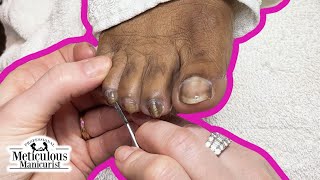 Twisting Turning and Curling Toenails Pedicure Tutorial [upl. by Noicpesnoc]