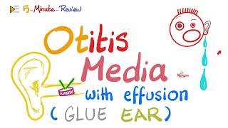 Otitis Media with effusions  Glue Ear [upl. by Koy571]