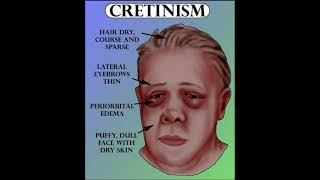 Pathophysiology of Cretinism [upl. by Ennaehr]