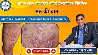 Morphea localized Scleroderma Skin Autoimmune Treatment at Dr Arpit Chopra Jain Modern Homoeopathy [upl. by Olin]