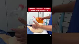 Nasopharyngeal Airway Insertion Technique  anesthesia bagmaskventilation airway [upl. by Llevron510]