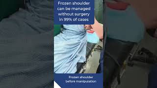 Frozen shoulder can be managed without any surgery in 99 of the cases Dr Shivakumar Kotra [upl. by Helfant]