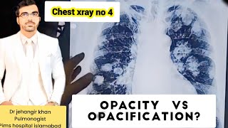 Understanding Chest XRays A Comprehensive Guide cxr chestxrayxray [upl. by Solange]