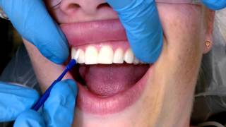 Tips For Applying Fluoride Varnish [upl. by Beach]